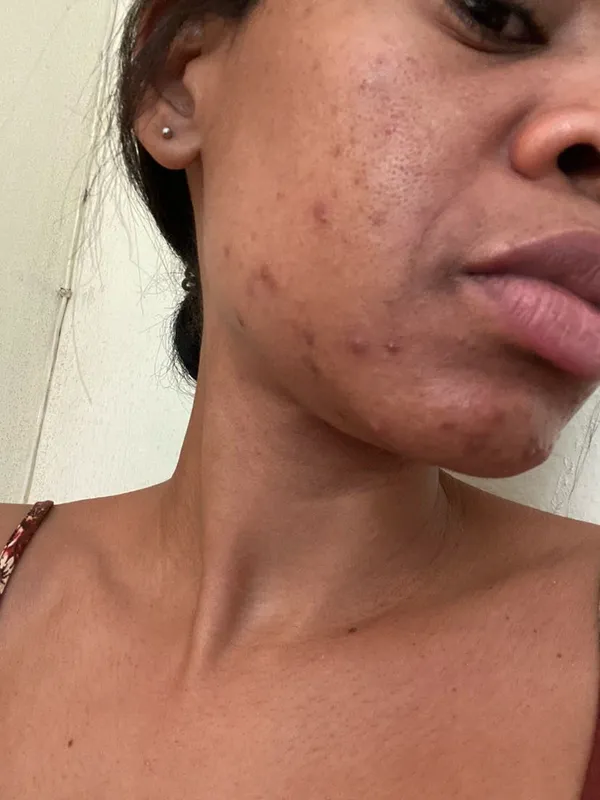 Acné severo — perfil derecho - antes del tratamiento