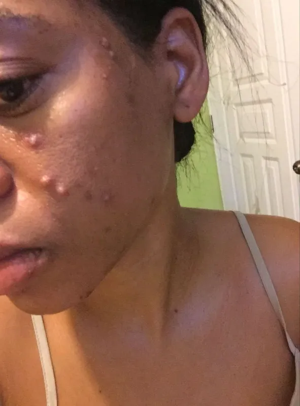 Acné severo — perfil izquierdo - antes del tratamiento