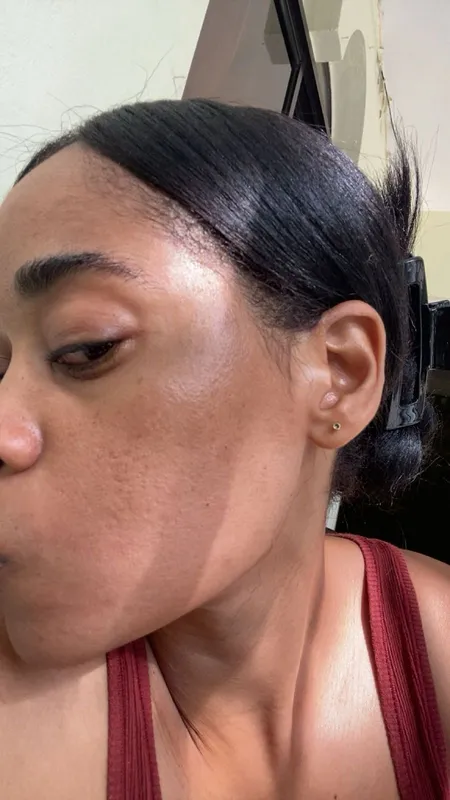 Acné severo — perfil derecho - después del tratamiento