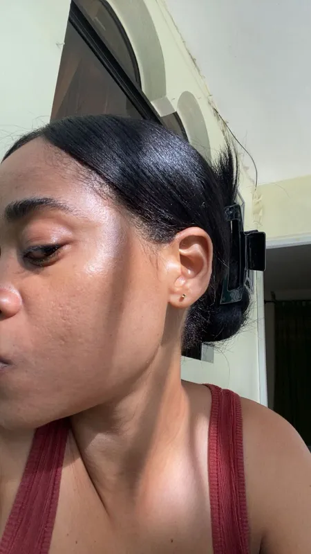 Acné severo — perfil izquierdo - después del tratamiento