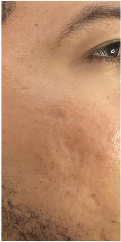 Botox — patas de gallo - antes del tratamiento