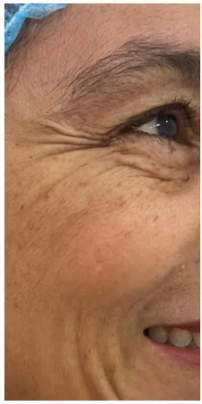 Cicatrices de acné - antes del tratamiento