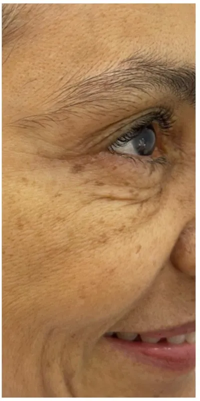 Cicatrices de acné - después del tratamiento