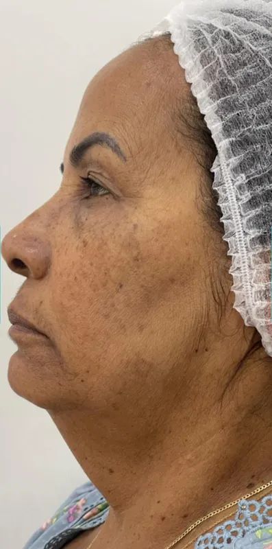 Manchas solares - antes del tratamiento