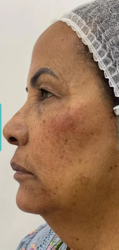 Manchas solares - después del tratamiento