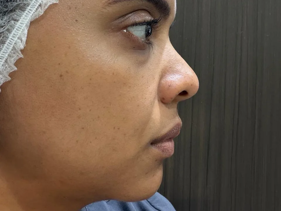 Perfilado mandibular - antes del tratamiento