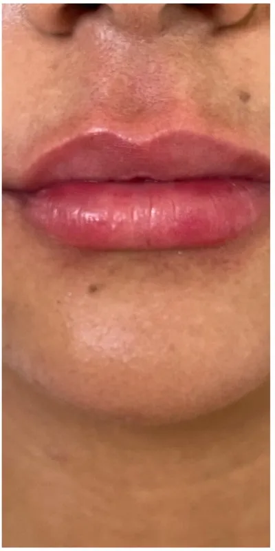 Relleno de labios — caso 2 - después del tratamiento