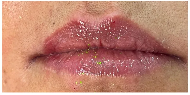 Relleno de labios — caso 3 - después del tratamiento
