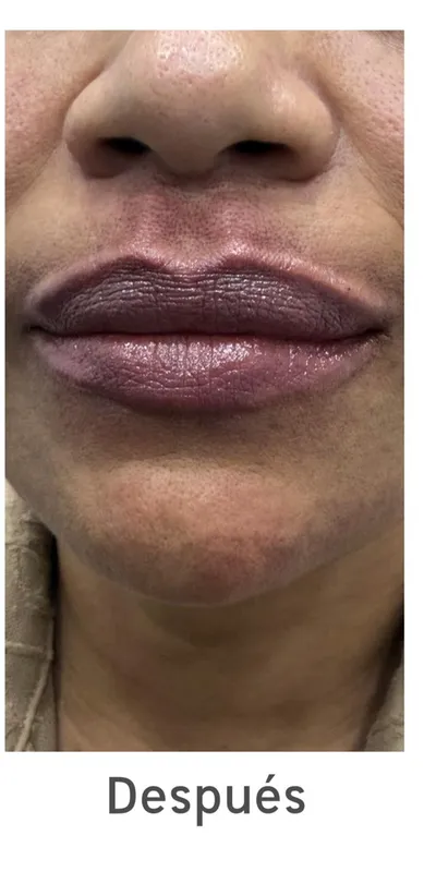 Relleno de labios — caso 4 - después del tratamiento