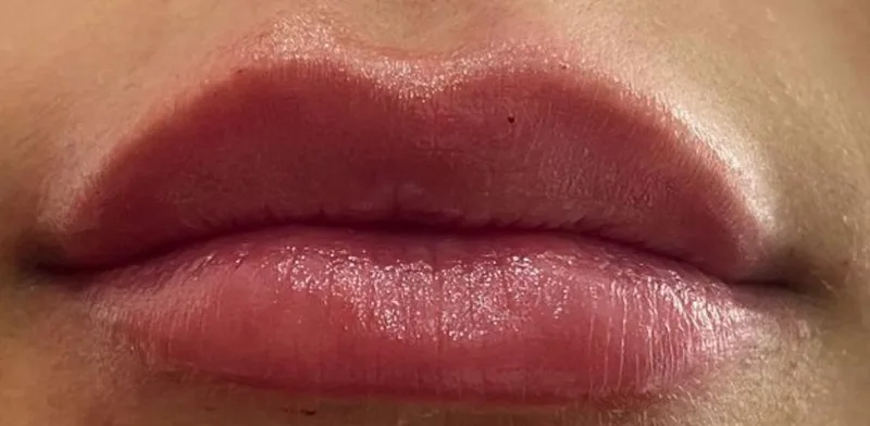 Relleno de labios - después del tratamiento