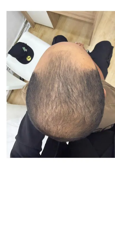 Alopecia androgenética - antes del tratamiento
